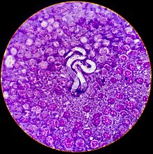 Microfilaria of Dirofilaria immitis (heartworms) in a lymph node of a dog with lymphoma. This baby nematode is in a pillow of intermediate-to-large, immature lymphocytes, exhibiting multiple criteria of cancer. Microfilaria of Dirofilaria immitis (Heartworms) Surrounded by Neoplastic Lymphocytes 1.jpg