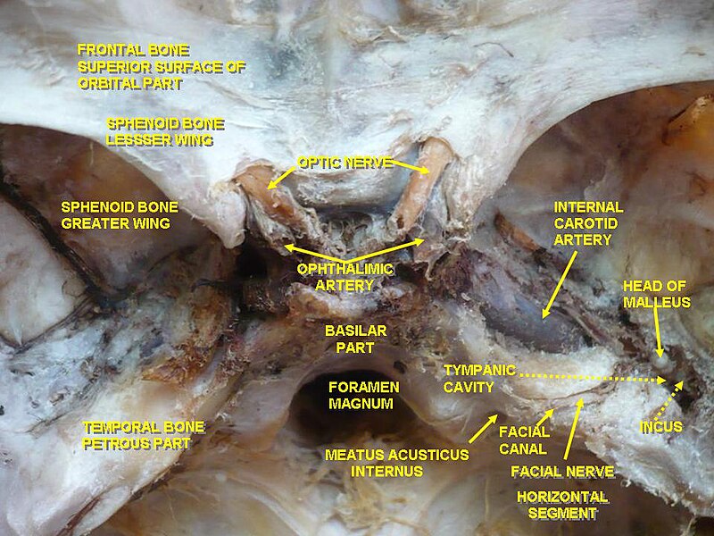 File:Occipital bone dissection.jpg