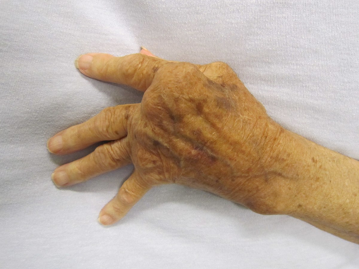 Arthritis - Wikipedia