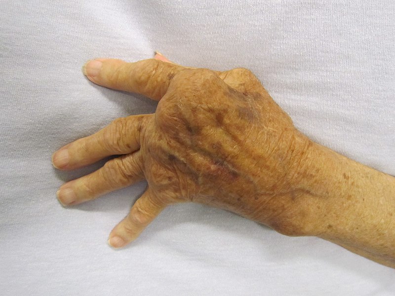 File:Rheumatoid Arthritis.JPG