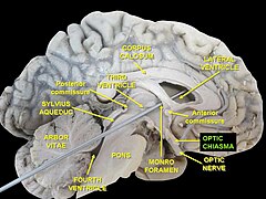 Bán cầu não trái, giao thoa thị giác được chú thích là optic chiasma màu xanh lá cây