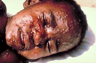 Boy with smallpox (1969). The last natural smallpox case was of Ali Maow Maalin, in Merca, Somalia, on 26 October 1977. Smallpox.jpg
