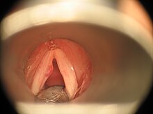 Image of a vocal fold polyp as seen through endoscopic examination. Stimmbandpolyp1.jpg