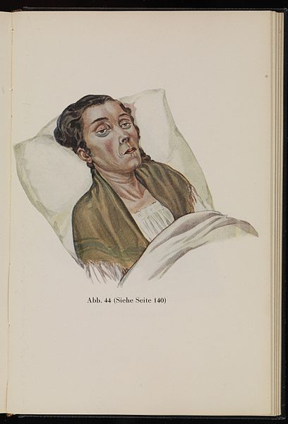 File:Woman suffering from ascites. Baumgartner, 1929 Wellcome L0074302.jpg