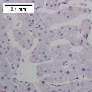 Primary effusion lymphoma Medical condition