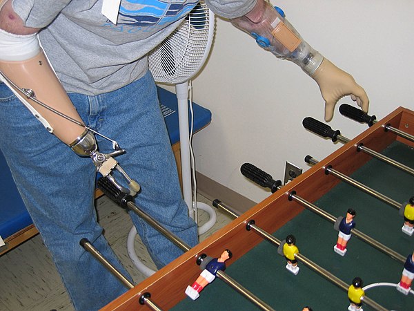 An example of two upper-extremity prosthetics, one body-powered (right arm), and another myoelectric (left arm).