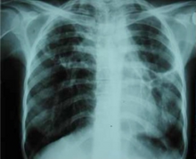 Chest X-ray showing bilateral fibrosis and pleural thickening in infection with non-tuberculosis mycobacteria. Bilateral fibrosis and pleural thickening in an infection with non-tuberculosis mycobacteria (frontal view).png