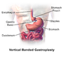 Thumbnail for Vertical banded gastroplasty surgery