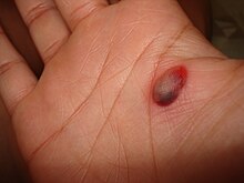 Blood blister close-up 2 by Esinam.jpg