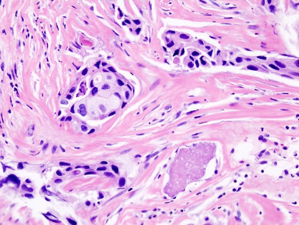 Histopathology: microscopic appearance of invasive ductal carcinoma of the breast. The slide is stained with Haematoxylin & Eosin.