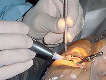 Cataract surgery, using a temporal-approach phacoemulsification probe (in right hand) and "chopper" (in left hand) being done under operating microscope at a navy medical center Cataract surgery.jpg