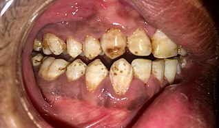 Dental Fluorosis.jpg