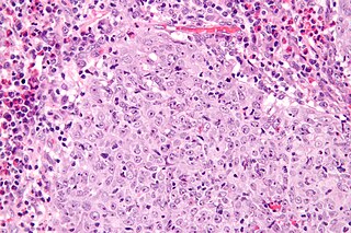 <span class="mw-page-title-main">Glassy cell carcinoma of the cervix</span> Medical condition