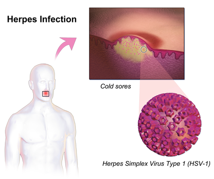 Herpeszvírus által okozott eruptionok a bőrön - A fejemre 