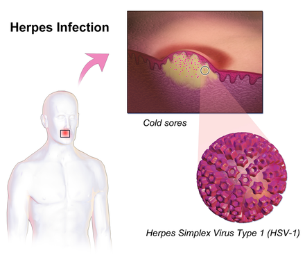 Herpes infection