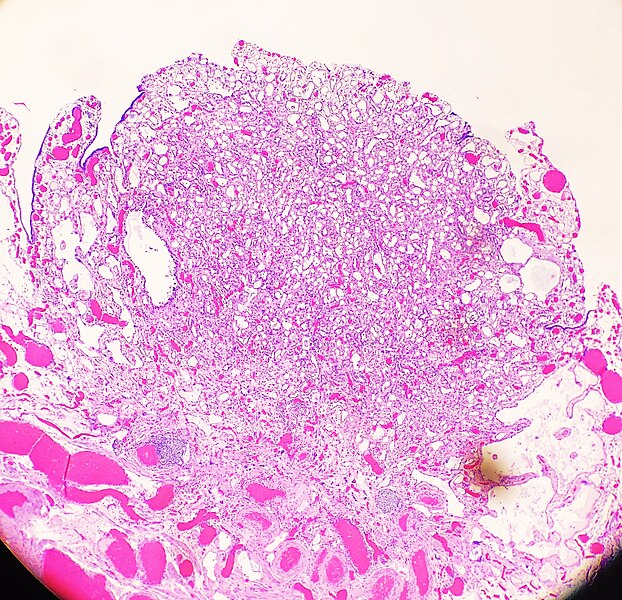 File:Histopathology of an adenomatoid tumor of the fallopian tube, low magnification.jpg