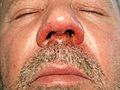 Staphylokokkeninfektion (Impetigo) der Nase