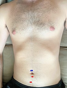 Hasson Entry: The two red lines mark the sites of the 5mm laparoscopic ports. The blue line above the umbilicus marks the site of the camera port Laparoscopic Port Site.jpg