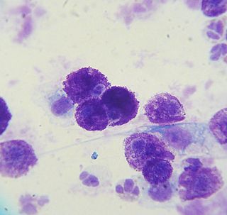 Mastocytoma hematologic cancer that has material basis in mast cells