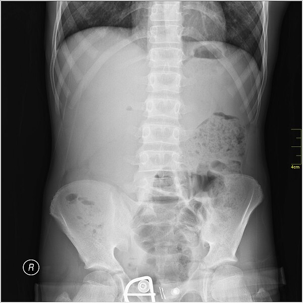 File:Medical X-Ray imaging PXY06 nevit.jpg