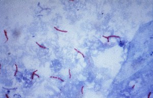 Mycobacterium tuberculosis (Ziehl-Neelsen stain)