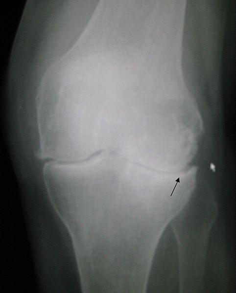 File:Osteoarthritis left knee.jpg