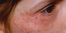 A skin rash in a person with porphyria Prfr1.jpg