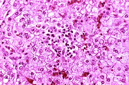 Description de l'image Reye's syndrome liver-histology.jpg.