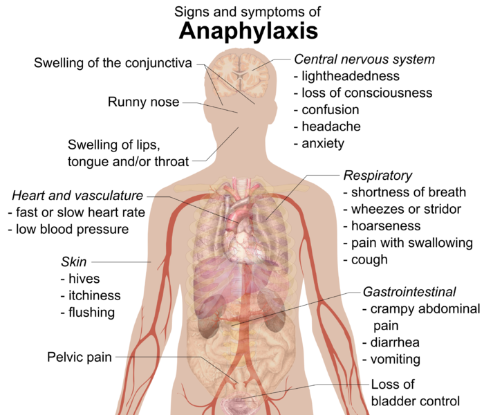 File:Signs and symptoms of anaphylaxis.png