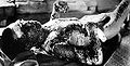 Popáleniny na jedné z obětí hirošimské pumy
