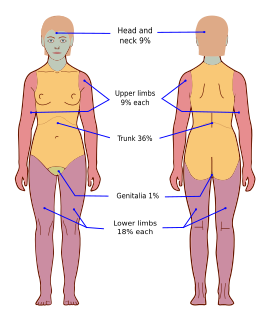 Wallace rule of nines