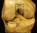 An anterior view of the right knee, showing anterior cruciate ligament with anteromedial (AM) and posterolateral (PL) bundles.