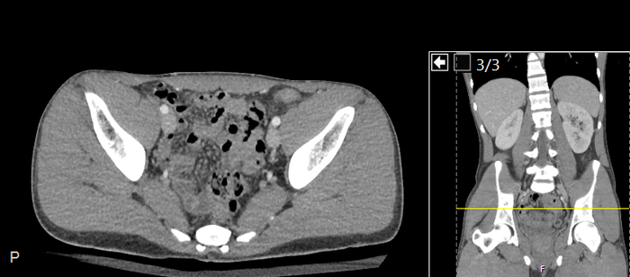 CT of a normal abdomen and pelvis, axial plane 222.png