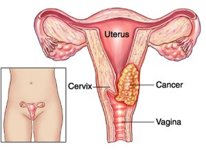 Cervical cancer