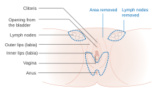 A partial vulvectomy of the bottom area of the vulva Diagram showing a simple or partial vulvectomy when the cancer is affecting the bottom part of the vulva and perineal area CRUK 079.svg