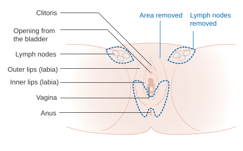 File:Diagram showing a simple or partial vulvectomy when the cancer is affecting the bottom part of the vulva and perineal area CRUK 079.svg