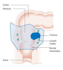 A diagram of local surgery for rectal cancer Diagram showing the area removed for a rectal cancer CRUK 286.svg