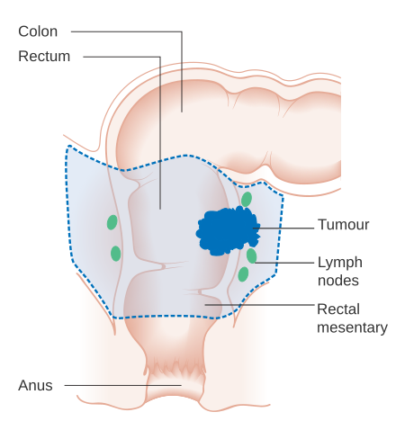 Tập_tin:Diagram_showing_the_area_removed_for_a_rectal_cancer_CRUK_286.svg