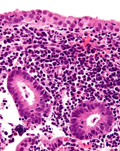 Endometritis - 2 - cropped - very high mag.jpg