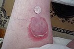 Thumbnail for Erythema annulare centrifugum