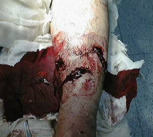 Gustilo type 2 fracture.png