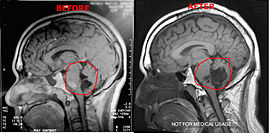 Intracranial Epidermoid Cyst - MRI scans 10.5 years apart Intracranial Epidermoid Cyst - MRI scans 10.5 years apart.jpg