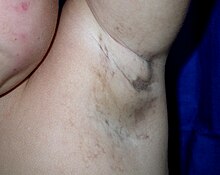 Incontinentia pigmenti forming along Blaschko's lines in a three-year-old girl Maculae Bloch-Sulzberger syndrome.jpg