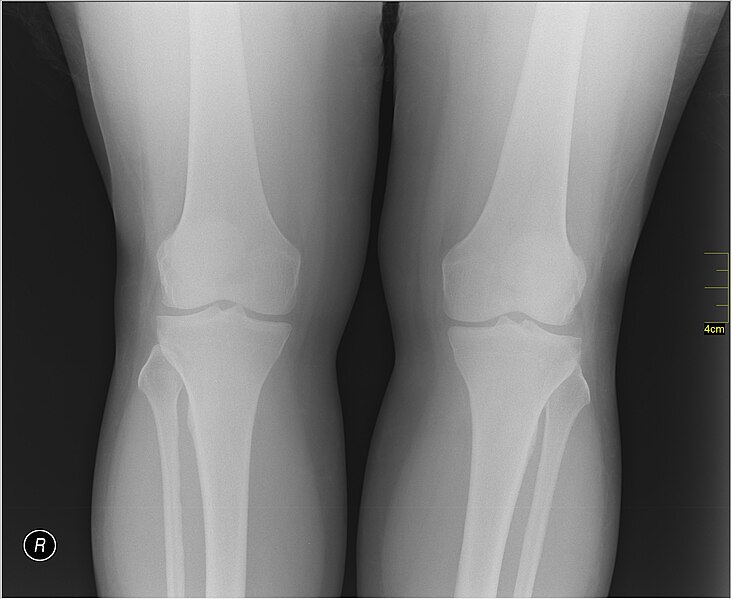 File:Medical X-Ray imaging RCQ06 nevit.jpg