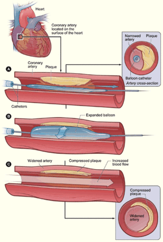 Perkutánna koronárna angioplastika s implantáciou stentu.