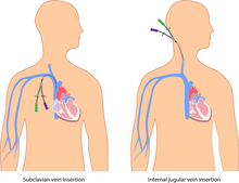 The percutaneous CVC is inserted directly through the skin. The subclavian (left), internal (right) or external jugular, or femoral vein is used. Percutaneous central venous catheters.png