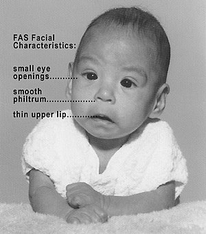 Fetal alcohol syndrome symptoms of Difference Between