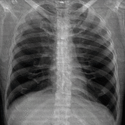 Projectionally rendered CT scan, showing the transition of thoracic structures between the anteroposterior and lateral view.