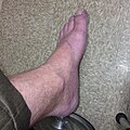 Raynaud's Left Foot