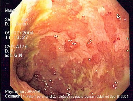Endoscopic image of ulcerative colitis affecting the left side of the colon. The image shows confluent superficial ulceration and loss of mucosal architecture.